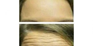 Anti-wrinkle treatment