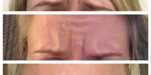 Anti-wrinkle treatment