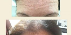 Anti-wrinkle treatment