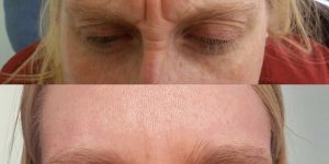 Anti-wrinkle treatment