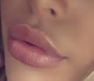 1ml lip filler to create this beautiful volume