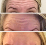 Anti-wrinkle treatment